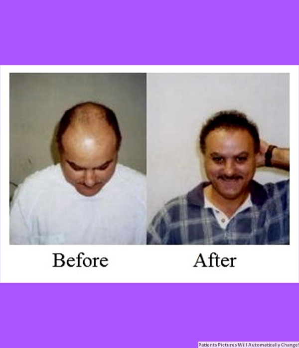  Patient Hair Transplant Cost is $3,000.00